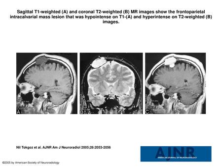 Sagittal T1-weighted (A) and coronal T2-weighted (B) MR images show the frontoparietal intracalvarial mass lesion that was hypointense on T1-(A) and hyperintense.