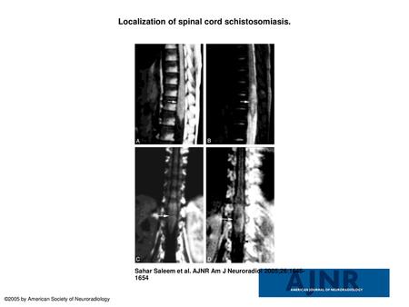 Localization of spinal cord schistosomiasis.
