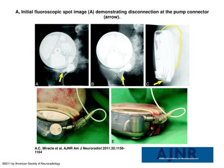 A, Initial fluoroscopic spot image (A) demonstrating disconnection at the pump connector (arrow). A, Initial fluoroscopic spot image (A) demonstrating.