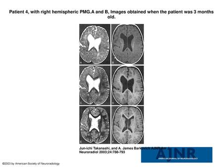Patient 4, with right hemispheric PMG