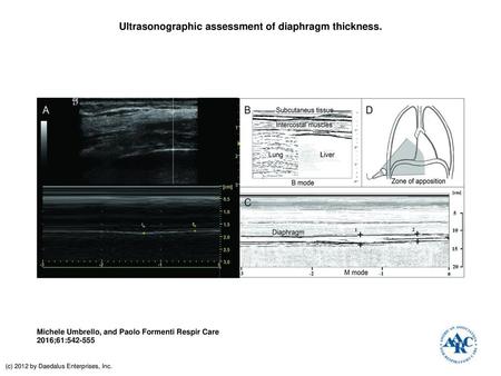 Ultrasonographic assessment of diaphragm thickness.