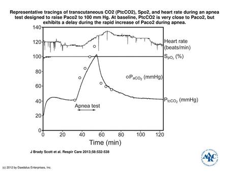 Representative tracings of transcutaneous CO2 (PtcCO2), Spo2, and heart rate during an apnea test designed to raise Paco2 to 100 mm Hg. At baseline, PtcCO2.
