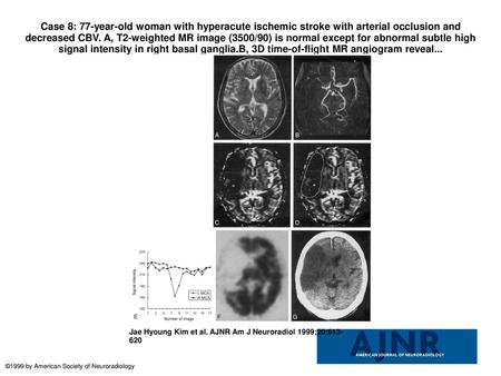 Case 8: 77-year-old woman with hyperacute ischemic stroke with arterial occlusion and decreased CBV. A, T2-weighted MR image (3500/90) is normal except.