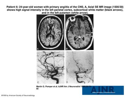 Patient 6: 24-year-old woman with primary angiitis of the CNS