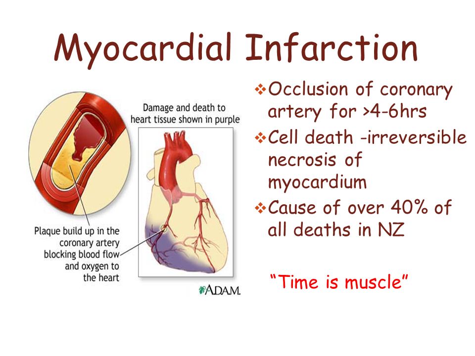 Myocardial infarction sexual intercourse