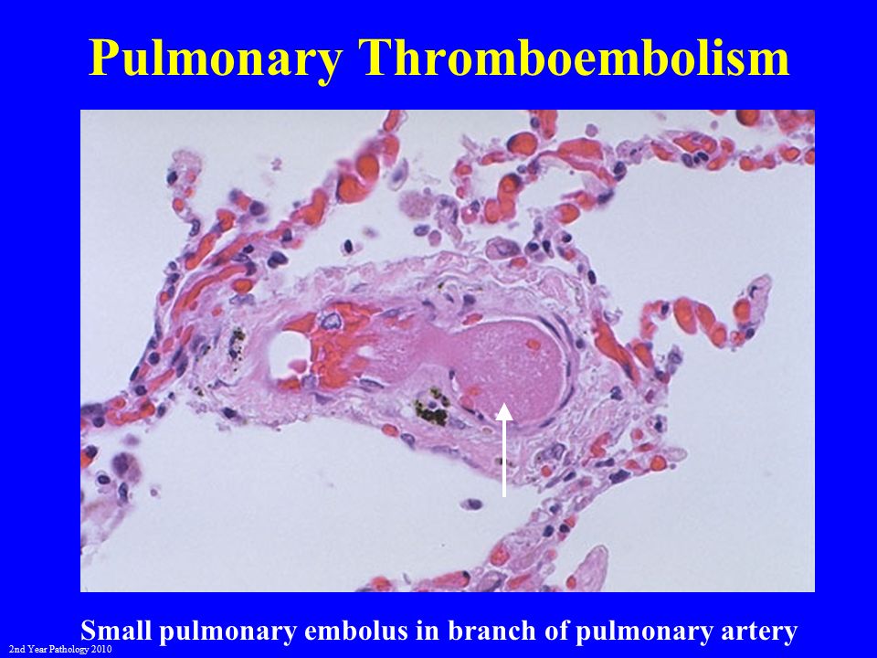 Тромбоз студфайл. Disseminated intravascular coagulation Syndrome. Disseminated intravascular coagulation Syndrome manifestations.