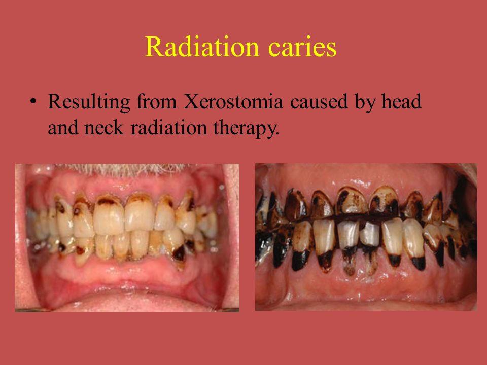 Radiographic Interpretation Of Dental Disease Ppt Video Online