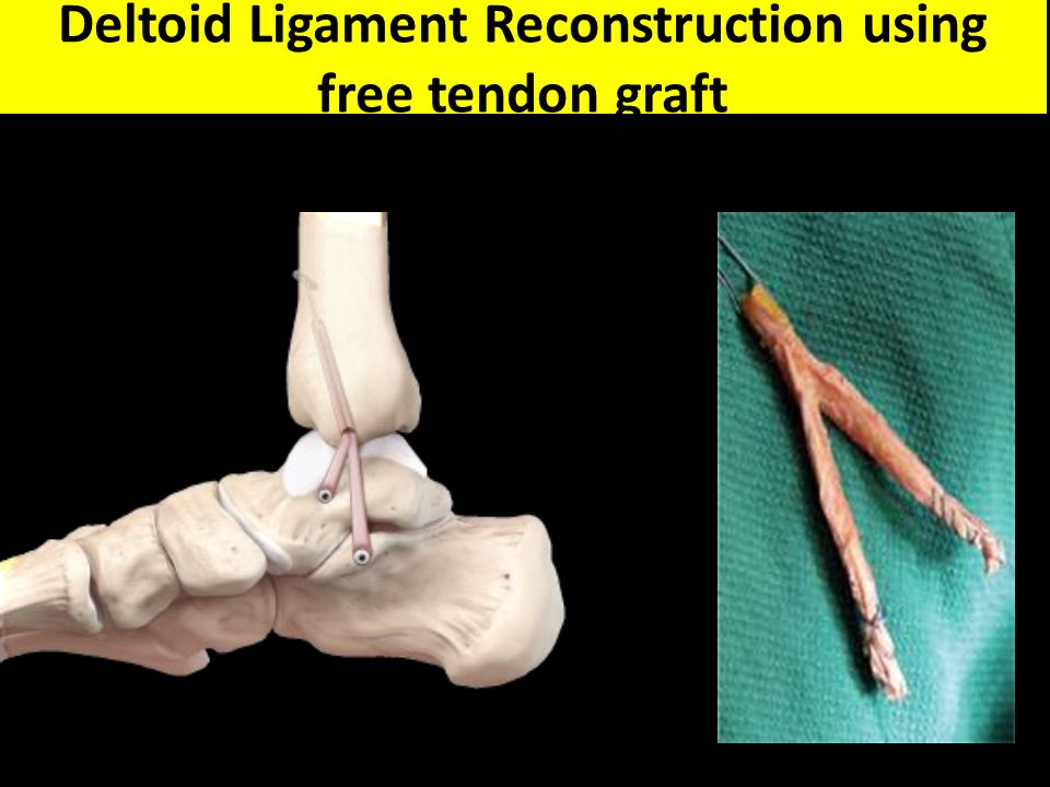 Ligament deltoid Deltoid Ligament