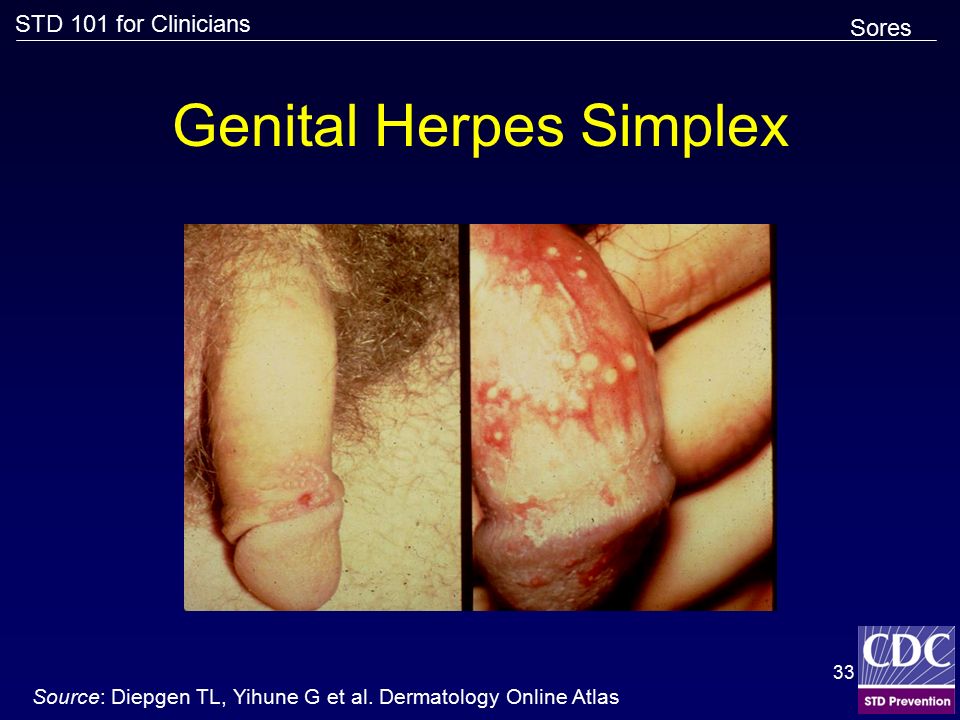Genital Herpes Simplex.