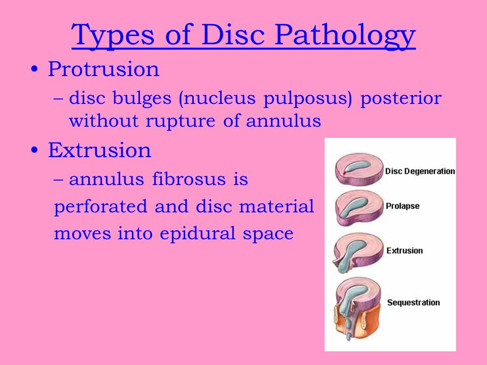 Types of Disc Pathology