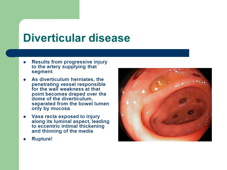 Diverticular disease Results from progressive injury to the artery supplyin...