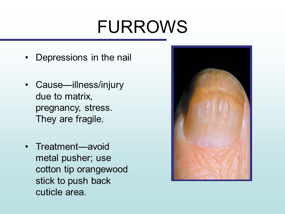 Chapter 10 Nail Disorders and Diseases - ppt video online download