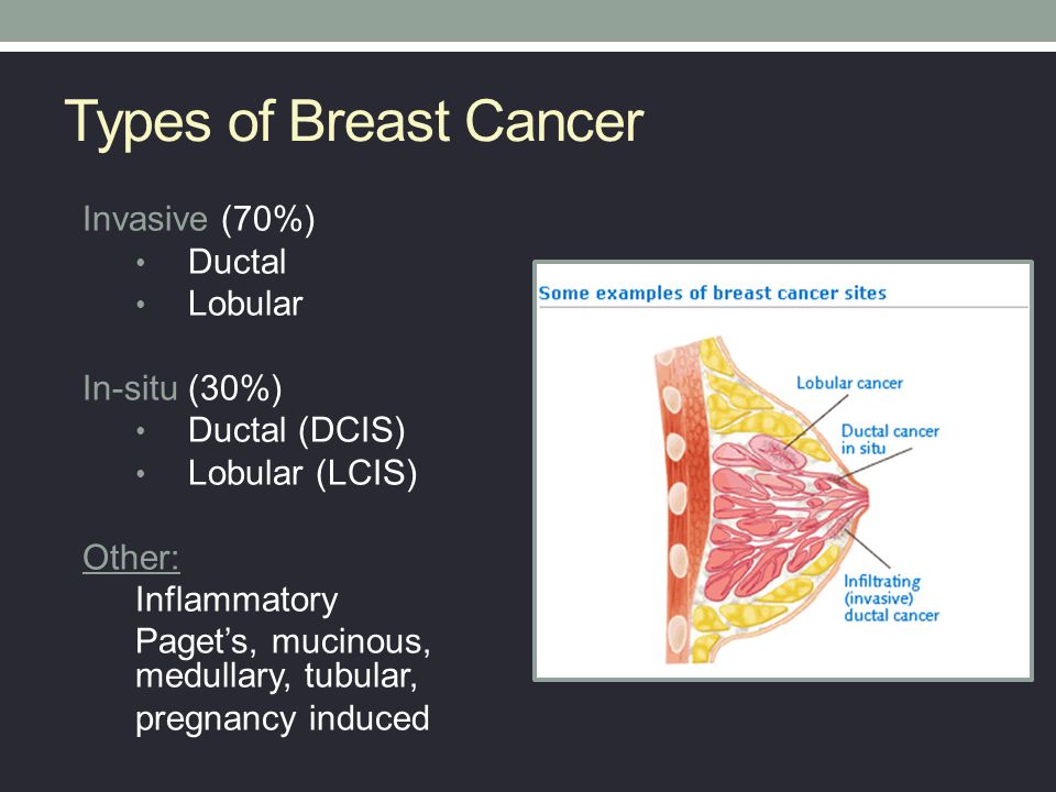 Types of Breast Cancer Invasive (70%) Ductal Lobular In-situ (30%) .