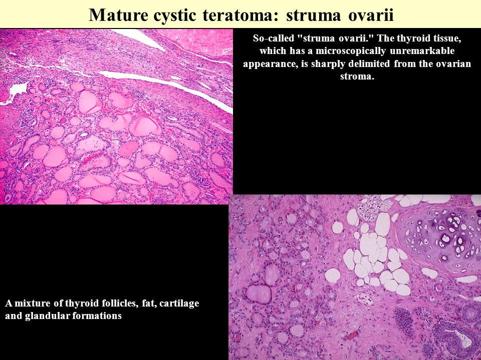 Mature Teratoma Of The Ovary Disease