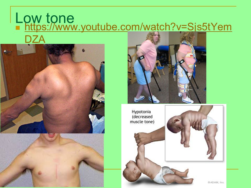 Abnormal Tone and Management Post Stroke - ppt download