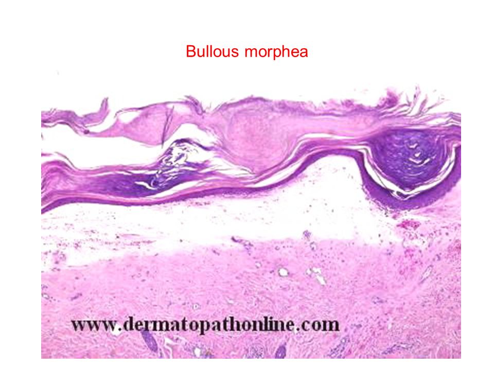 morphea histopathology