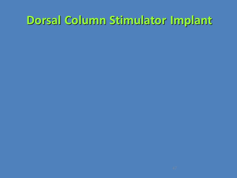 Dorsal Column Stimulator Implant