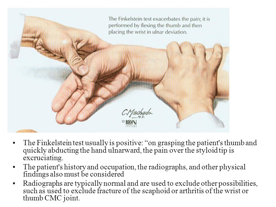De Quervain Tenosynovitis Ppt Video Online Download