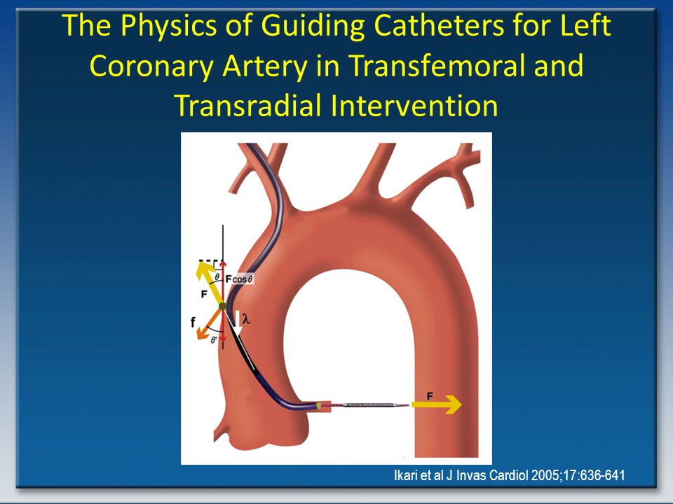 The Physics of Guiding Catheters for Left Coronary Artery in Transfemoral and Transradial Intervention