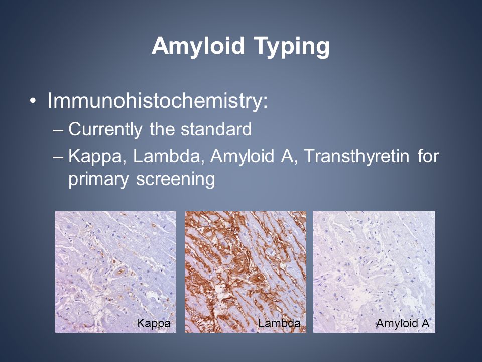 Pathologic Diagnosis in Amyloidosis - ppt video online download