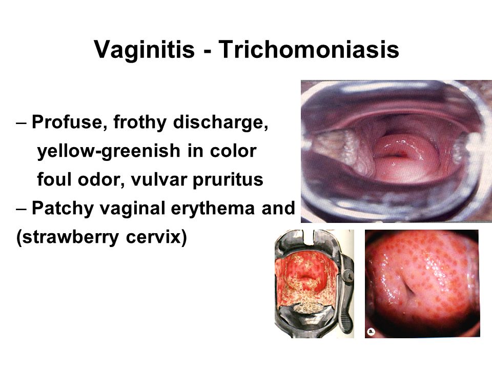 What Your Vaginal Discharge Could Mean