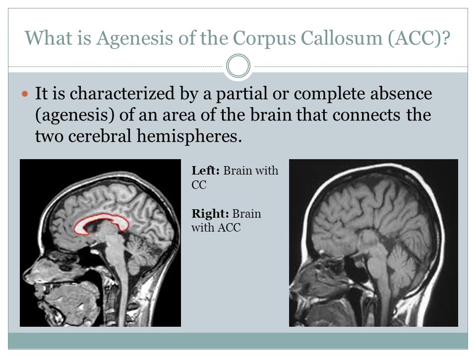 Agenesis of the corpus callosum Presented by: Mallory kowaleski - ppt  download