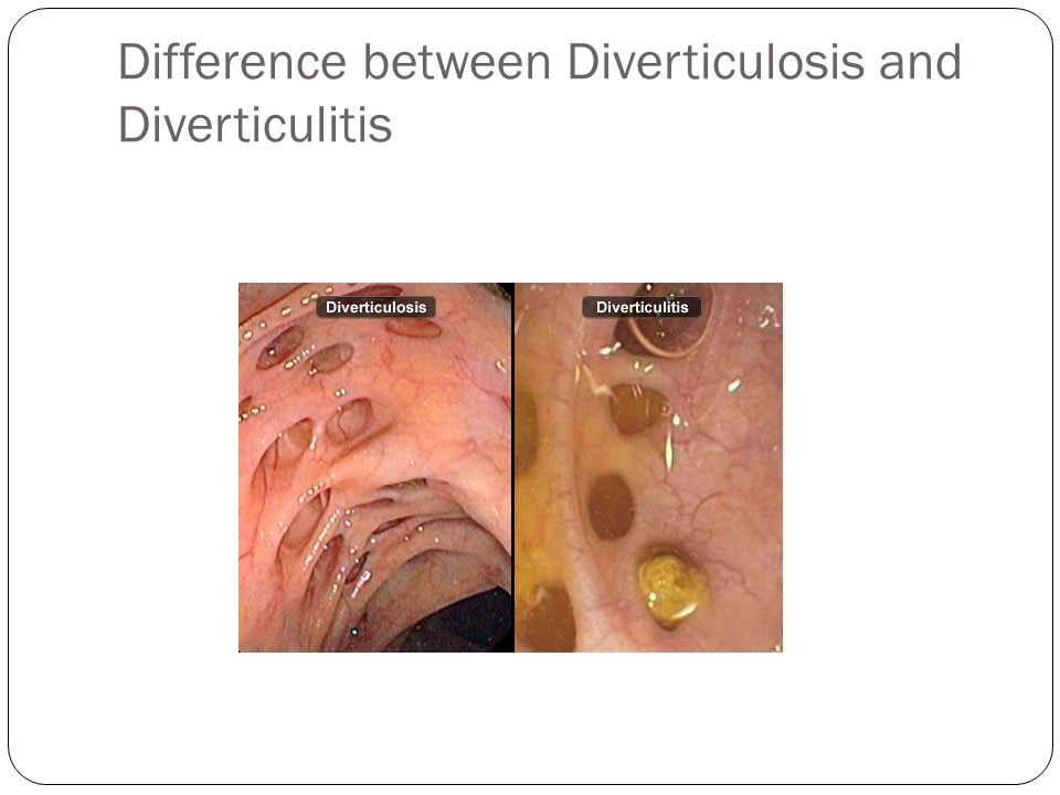 DIVERTICULOSIS AND DIVERTICULITIS - ppt video online download