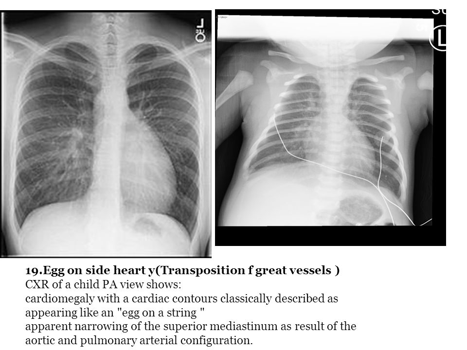 Various Chest Disease Their Xr Findings Appearance Ppt Video