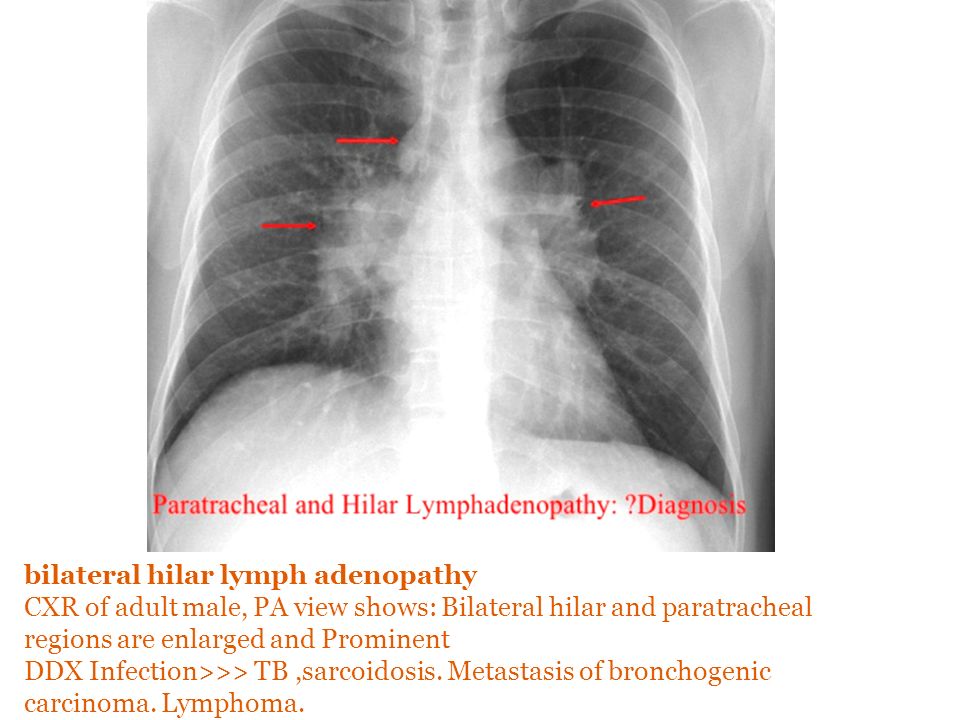 Various Chest Disease Their Xr Findings Appearance Ppt Video