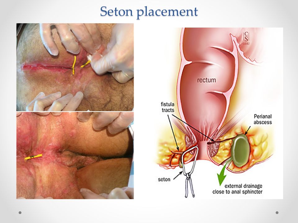 Anal Fissure, Fistula And Abscess