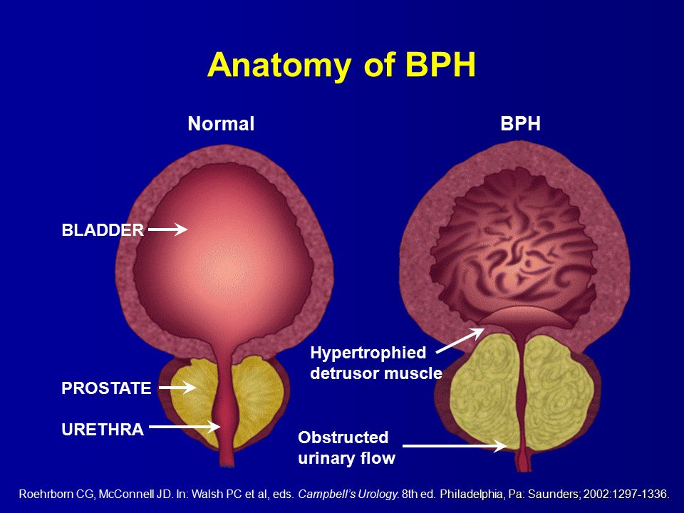 benign prostatic hypertrophy icd 10)