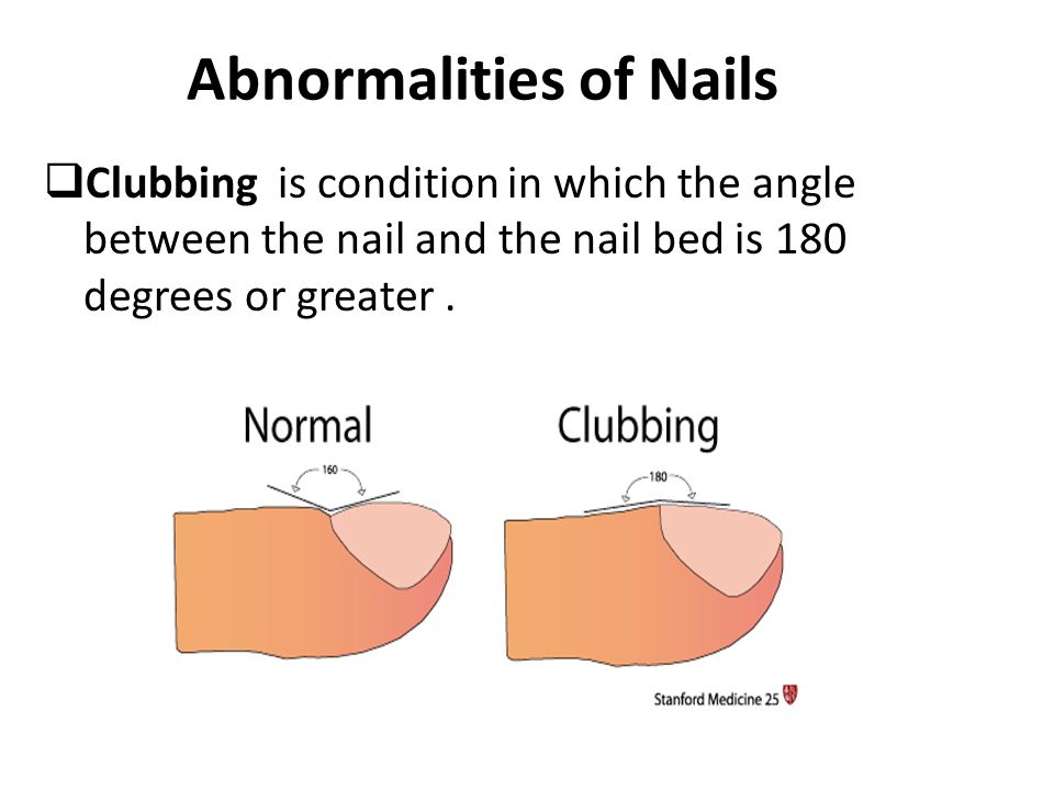 Being doctor - #Nail 1.Koilonychia:Spoon shaped concave nail 2.Clubbing:loss  of nail bed angle(Onychodermal angle) | Facebook