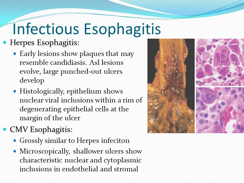 Disorders Of The Esophagus Ppt Video Online Download