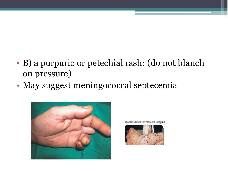 B) a purpuric or petechial rash: (do not blanch on pressure)