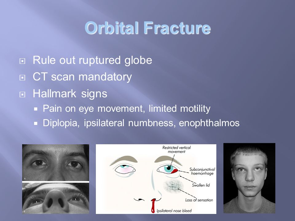 Orbital And Ocular Trauma Ppt Video Online Download