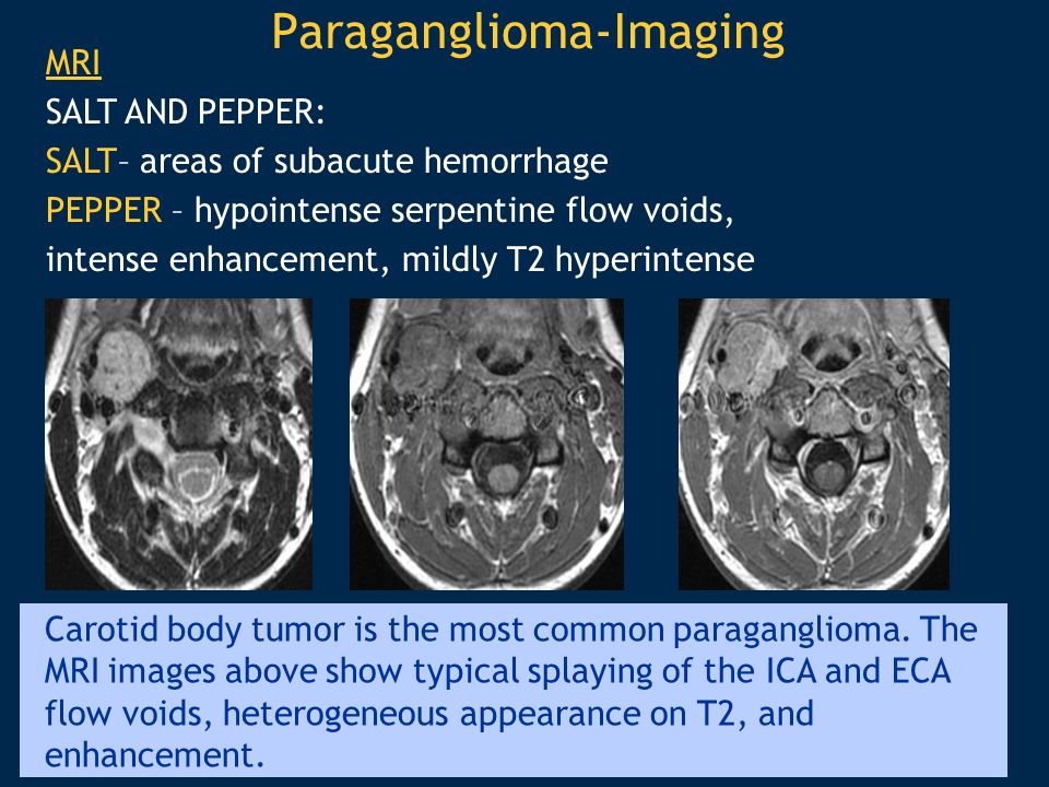 Vascular Head and Neck lesions: Imaging and Management Essentials - ppt  video online download