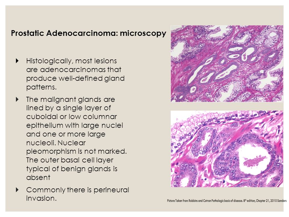 histological features of prostate adenocarcinoma)