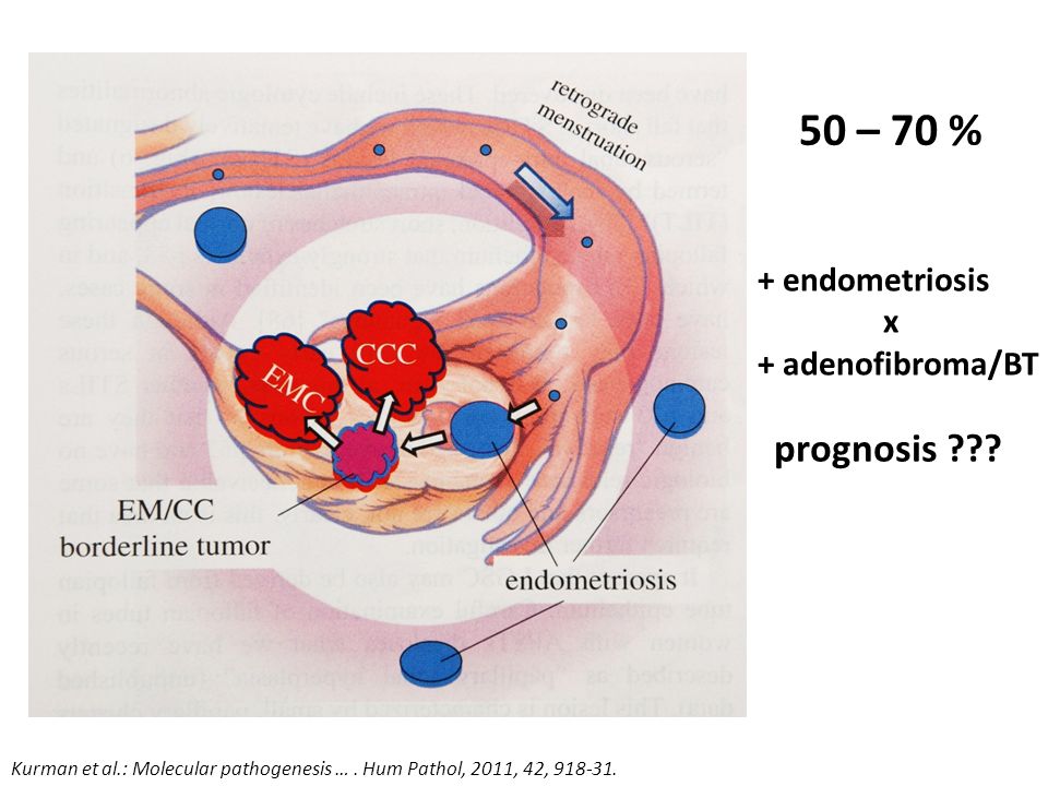 50 – 70 % prognosis + endometriosis x + adenofibroma/BT