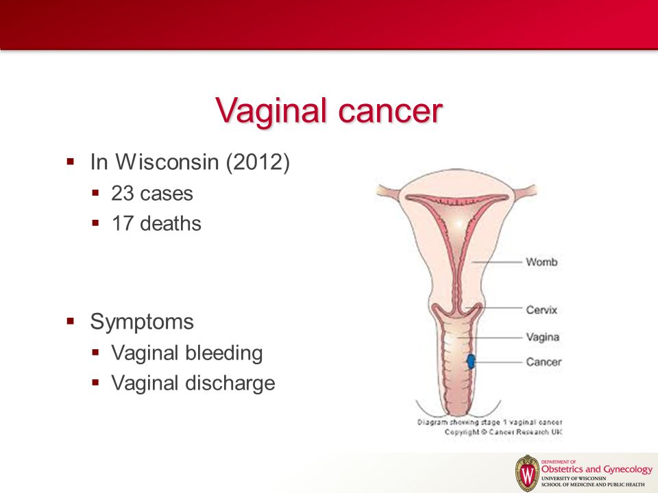 What is gynaecological cancer and what are the symptoms