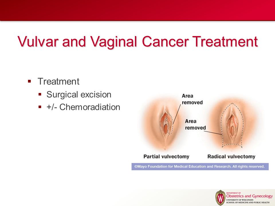 Common types of vaginal infections