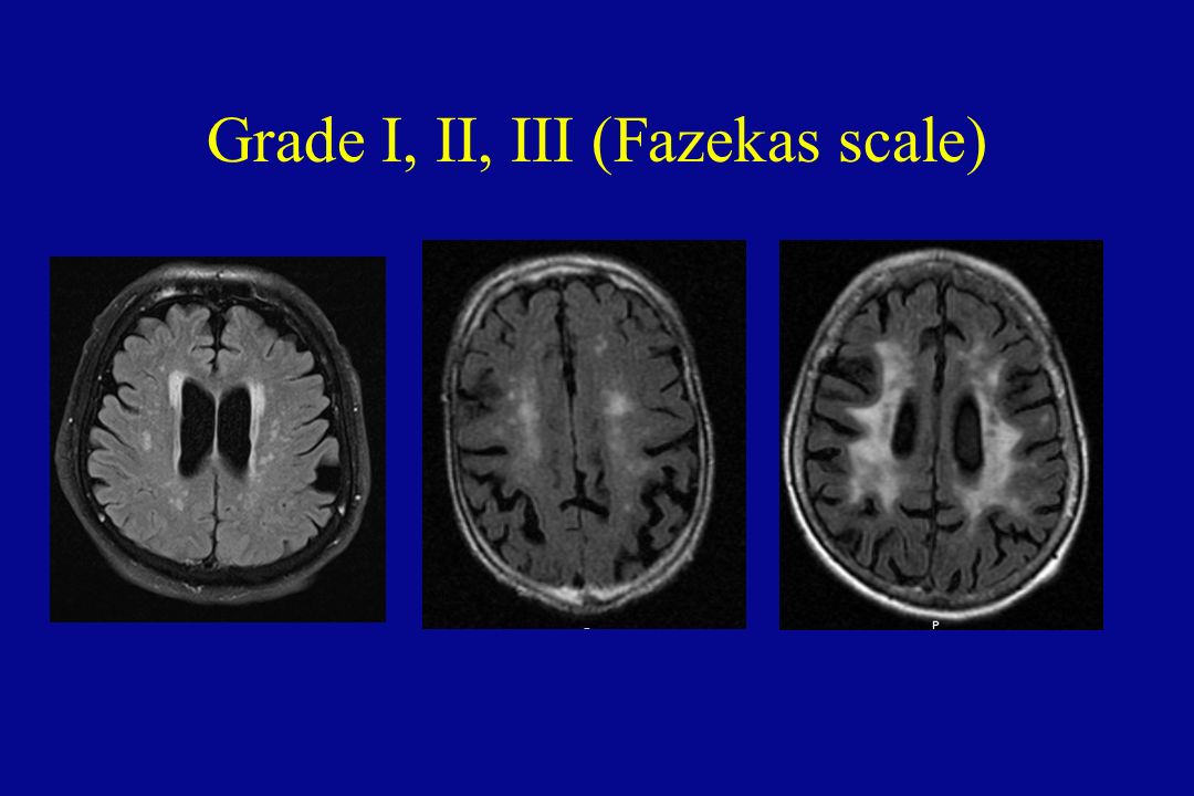 Микроангиопатия головного мозга fazekas. Лейкоареоз Fazekas 1. Фазекас мрт. Fazekas II мрт. Лейкоареоз головного мозга на кт.