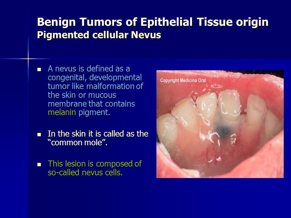 Benign Tumors of Epithelial Tissue origin Pigmented cellular Nevus