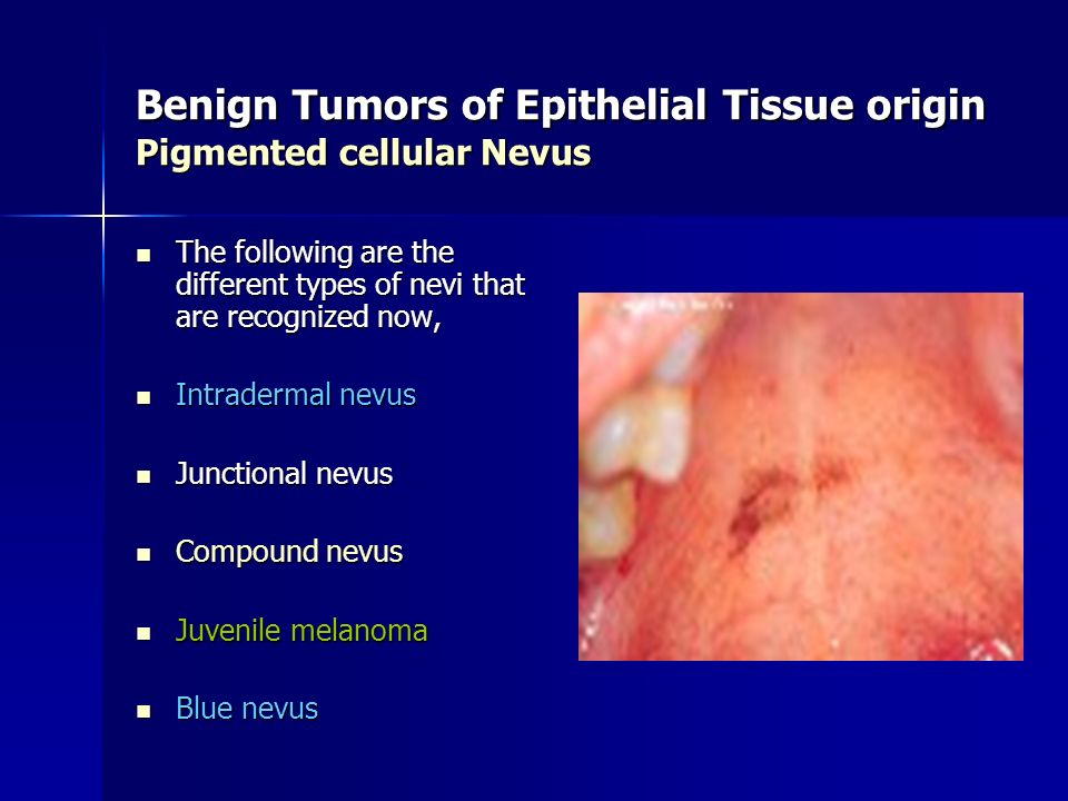 Benign Tumors of Epithelial Tissue origin Pigmented cellular Nevus