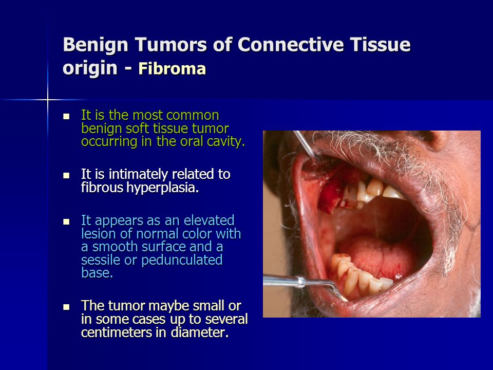 Benign Tumors of Connective Tissue origin - Fibroma