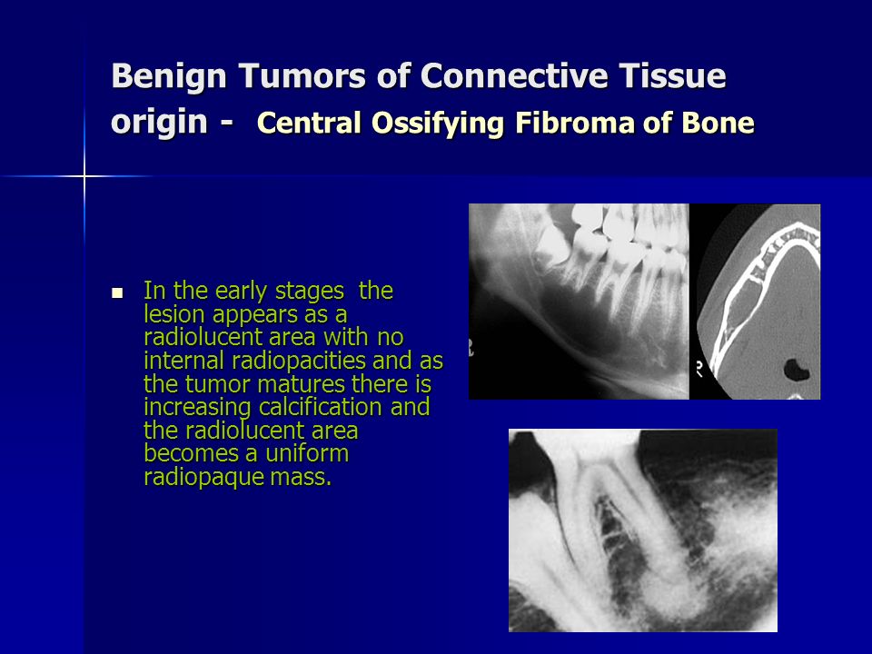Benign Tumors of Connective Tissue origin - Central Ossifying Fibroma of Bone