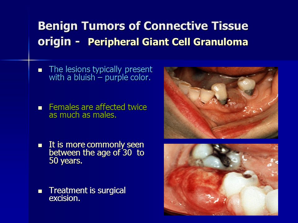 Benign Tumors of Connective Tissue origin - Peripheral Giant Cell Granuloma
