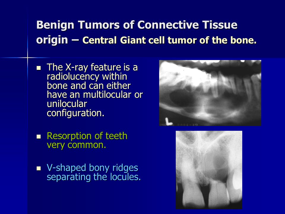Benign Tumors of Connective Tissue origin – Central Giant cell tumor of the bone.