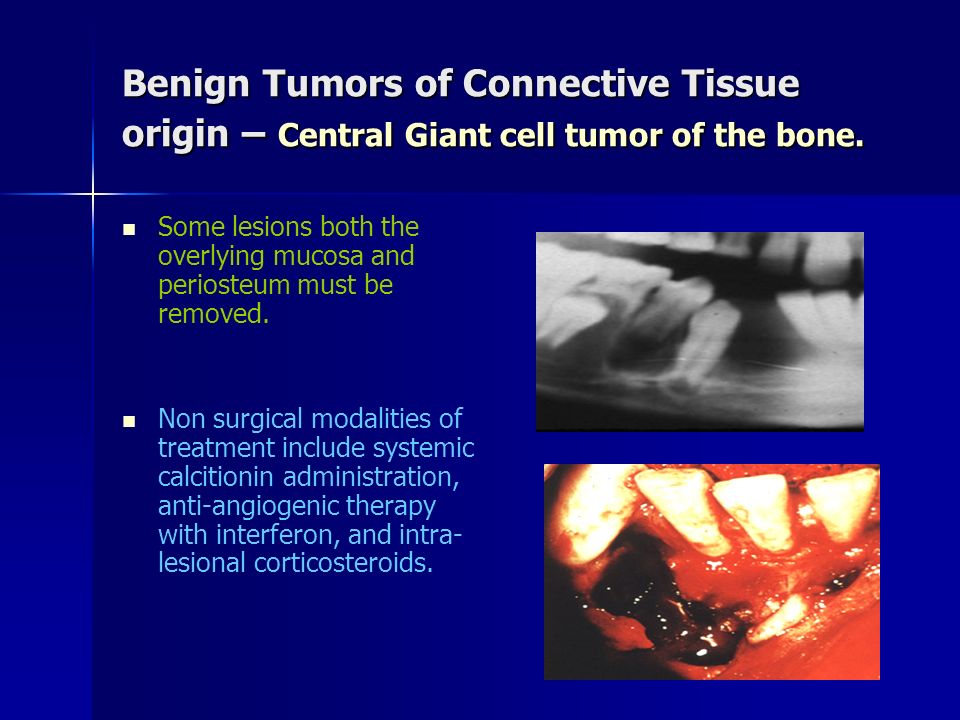 Benign Tumors of Connective Tissue origin – Central Giant cell tumor of the bone.
