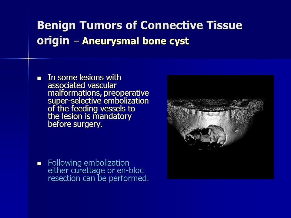 Benign Tumors of Connective Tissue origin – Aneurysmal bone cyst