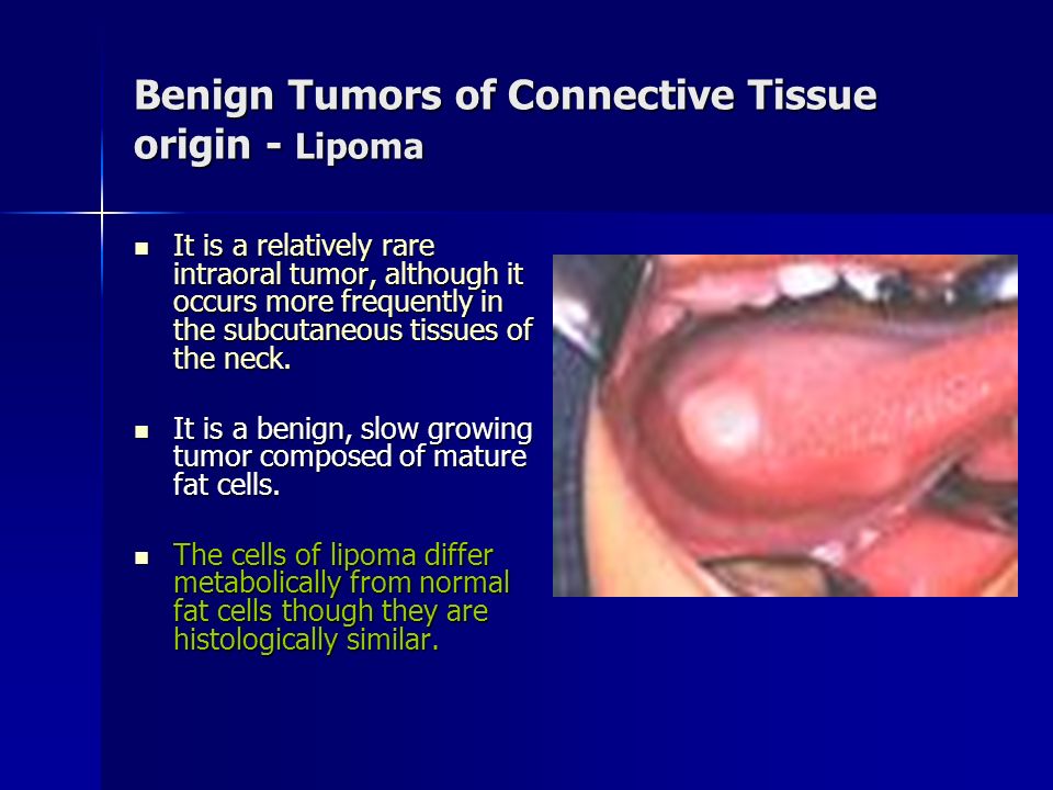 Benign Tumors of Connective Tissue origin - Lipoma